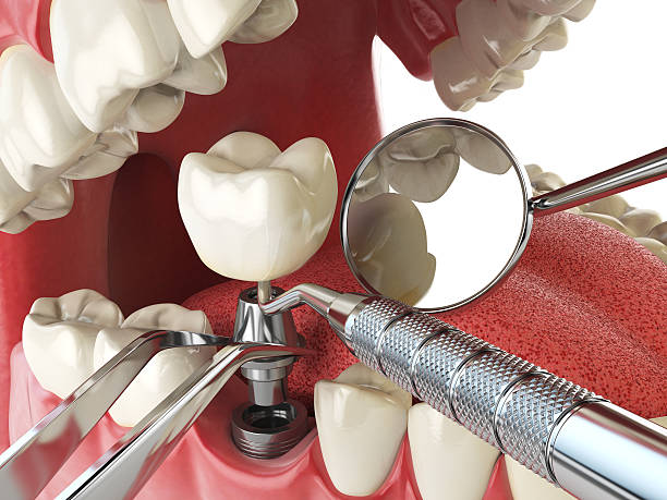 Best Urgent Care for Lost Fillings or Crowns in Georgiana, AL